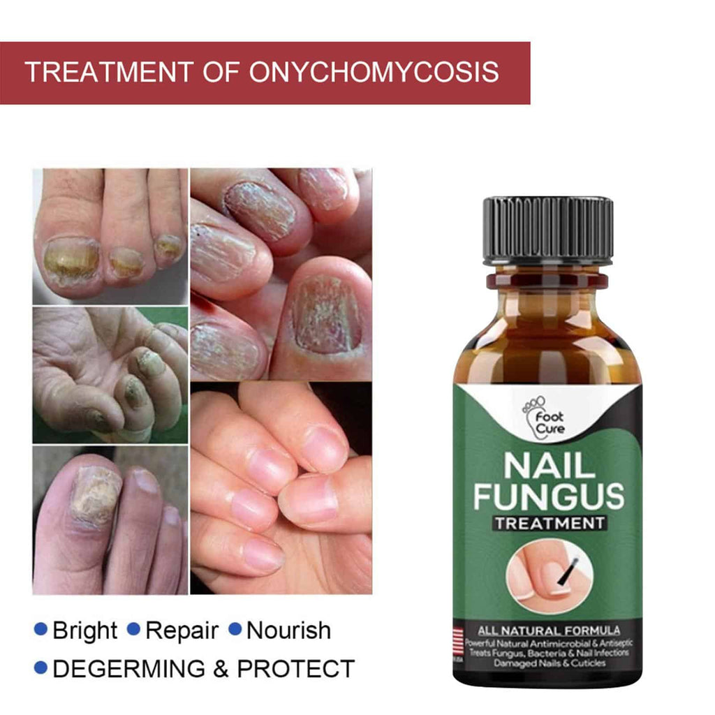 10ml Nail Fungal Infection Treatment Damaged Broken Nail